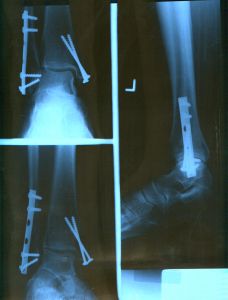 ankle x-ray - hardware.jpg
